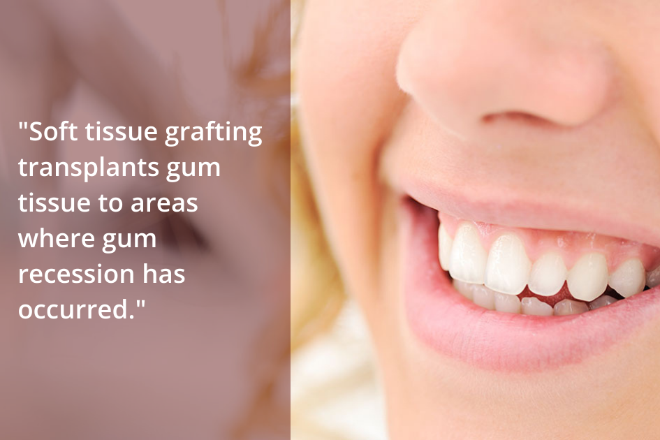 Soft tissue grafting is an essential procedure for improving gum health by transplanting gum tissue in areas where recession has occurred.